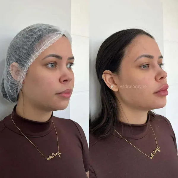 Antes e depois de harmonização facial realizado pela Dra. Lorayne Aguiar