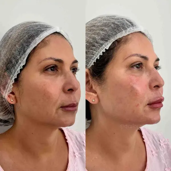 Resultado de harmonização facial com aspecto natural
