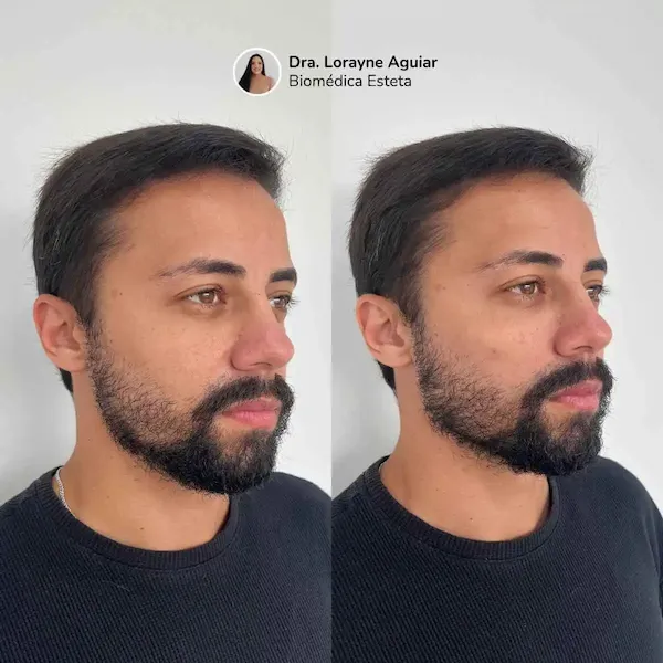 Antes e depois de harmonização facial em paciente masculina