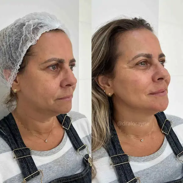 Resultado de harmonização facial com rejuvenescimento natural