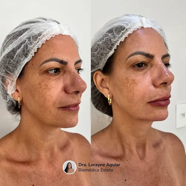 Antes e depois de tratamento estético facial com melhora de contorno