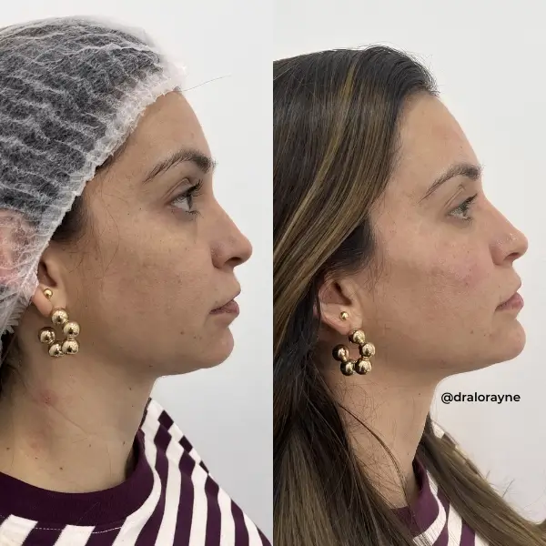 Resultado de realce facial natural