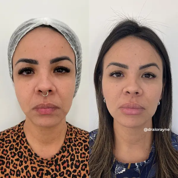 Resultado de realce facial natural