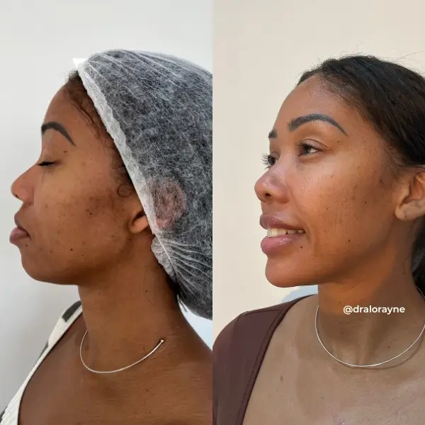 Resultado de realce facial natural